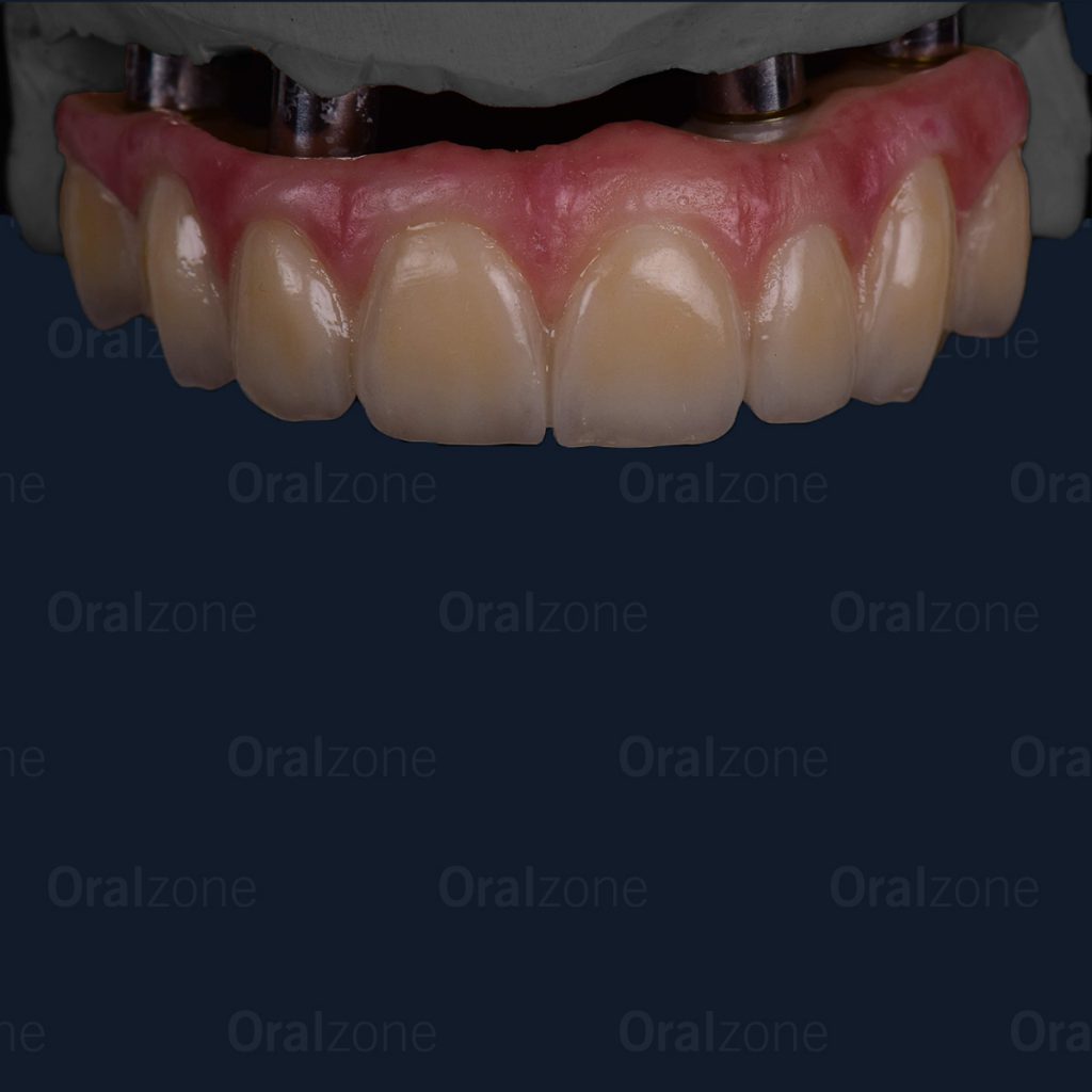 In this case, the patient was missing the upper left incisor (UL2) and premolar (UL4). The adjacent teeth were stained and showing old crown margins.