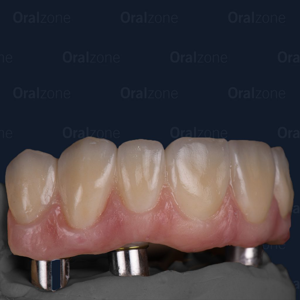 This case needed some extra attention. Thankfully with team oralzone’s knowledge on implant cases we can find a solution for any case.