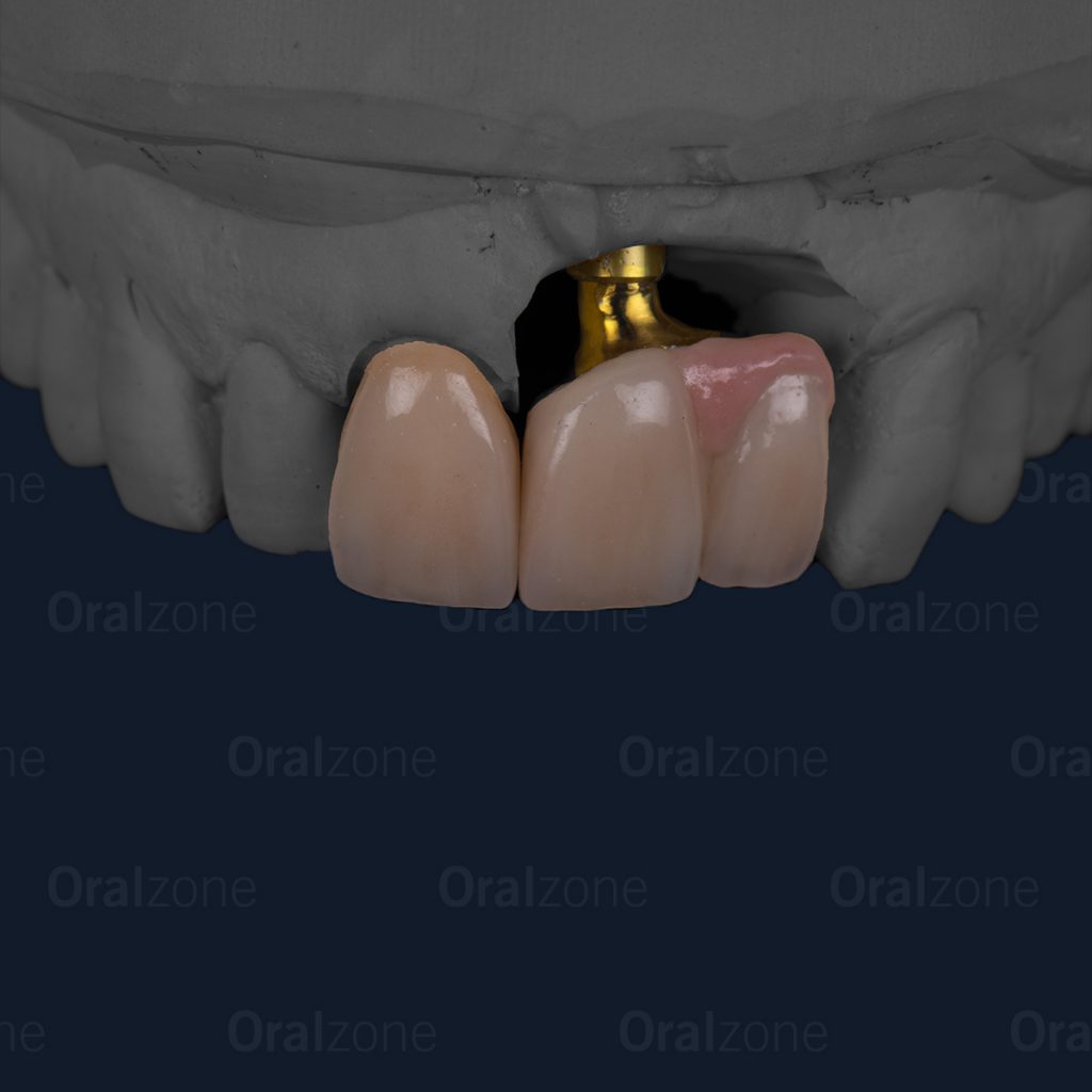 We here at oralzone like to keep everything in house and not have to depend on third party milling centers.
