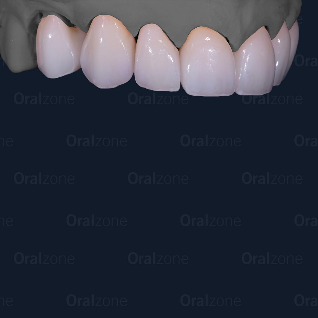 Big cases tend to give us issues if a proper protocol is not followed. In this case the clinician started off by asking oralzone for a digital waxup which we 3D printed.