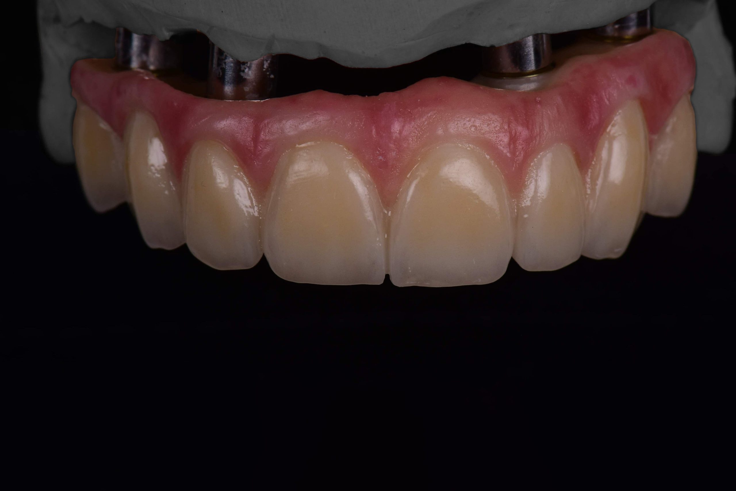 2- Couronnes et ponts sur implant - corrected