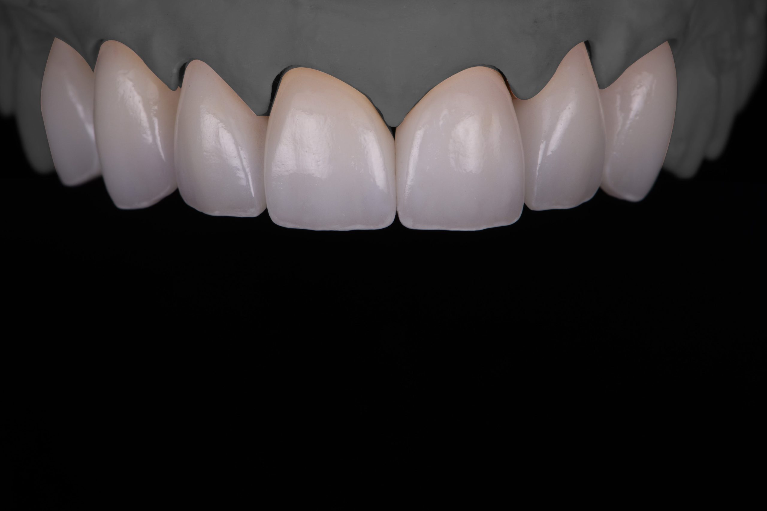 4-Facettes - Corrected